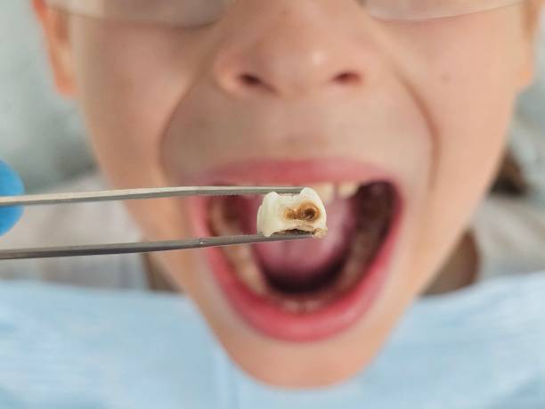 Best Emergency Dentist for Lost Fillings or Crowns in Siler City, NC